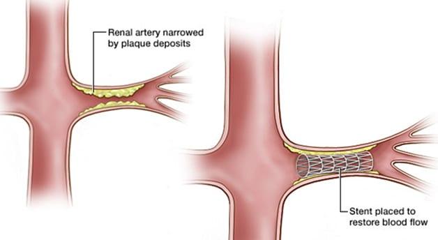 Renal Vein Thrombosis